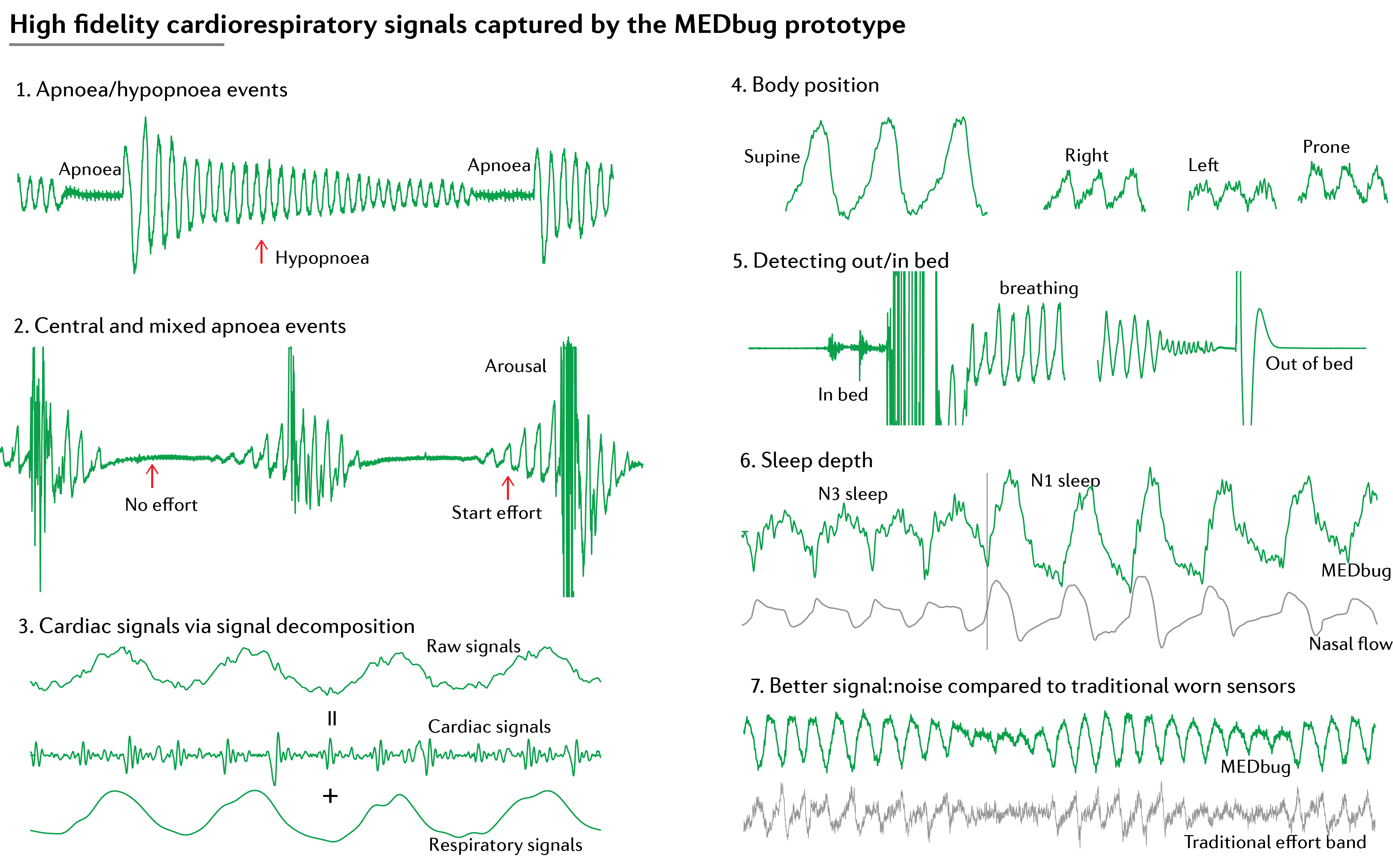 Examples of cardiorespiratory signals captured by the MedBug prototype across apnoea events, cardiac decomposition, body position, bed state and sleep depth